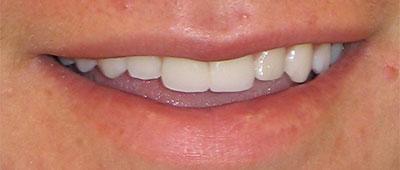 Smile gallary case 1 - after implant