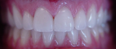 Smile gallary case 3 - after implant