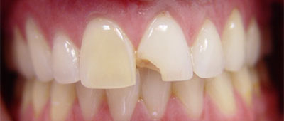 Smile gallary case 3 - before implant