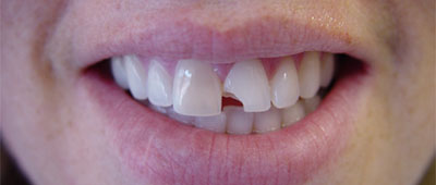 Smile gallary case 4 - before implant