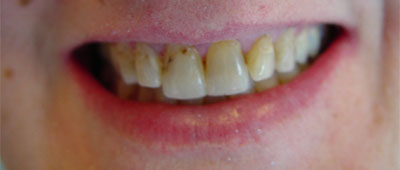 Smile gallary case 5 - before implant